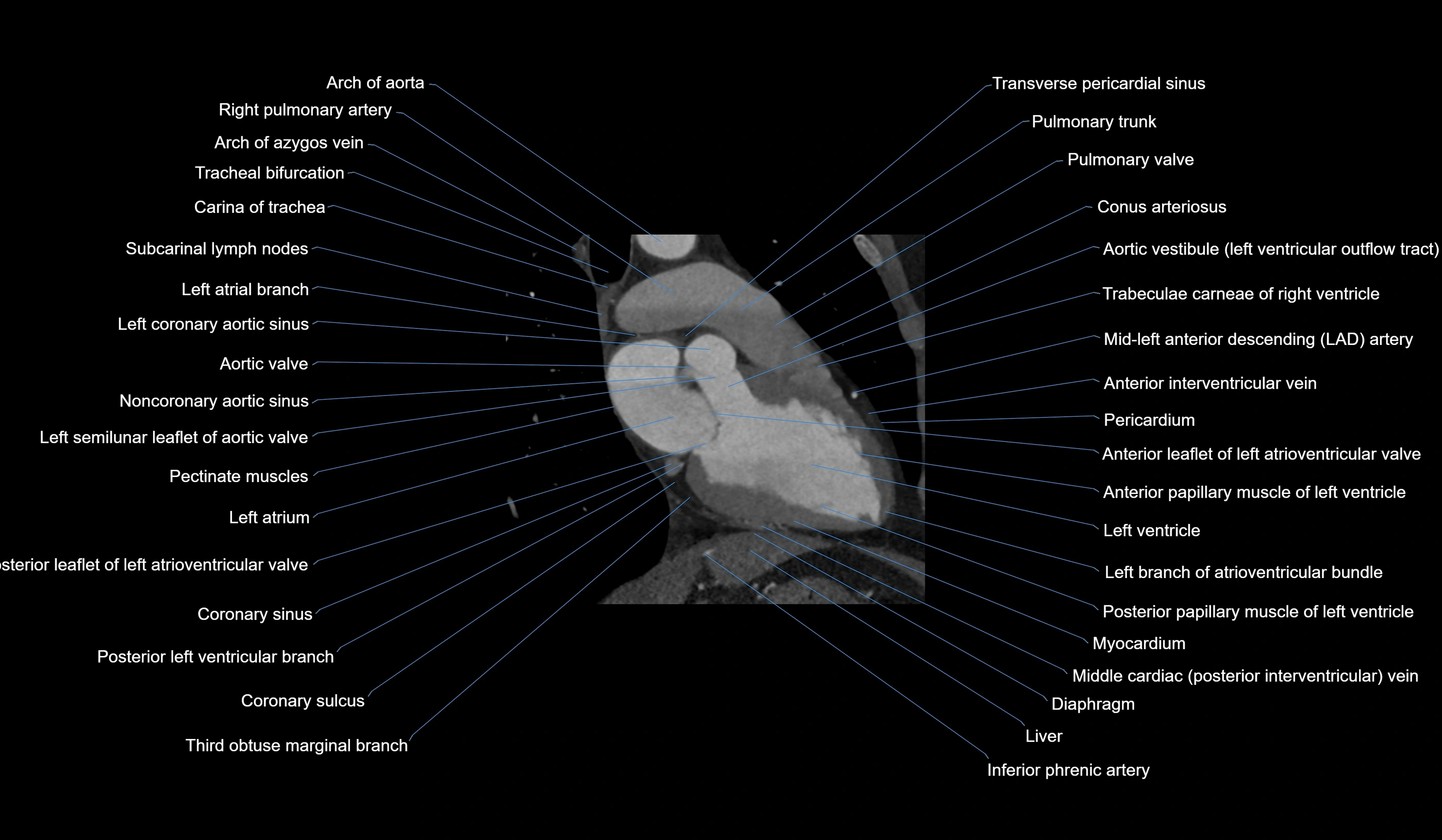 CT heart (coronary angiogram) 2 chamber view cross sectional anatomy labelled radiology image-00019.webp